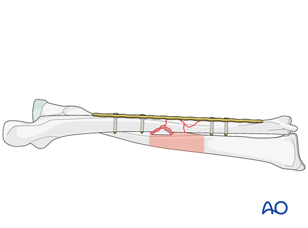 orif bridge plating