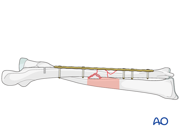 orif bridge plating