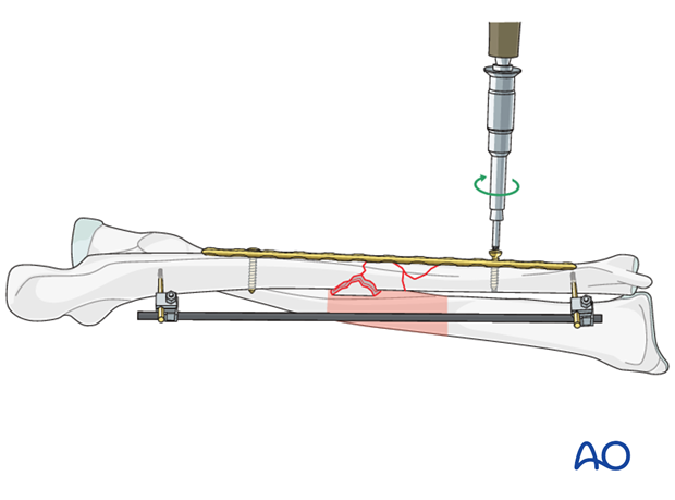 Preliminary fixation of the ulnar plate (after reduction with external fixator)