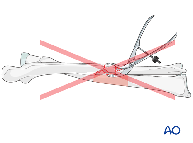 Soft-tissue considerations in comminuted zone