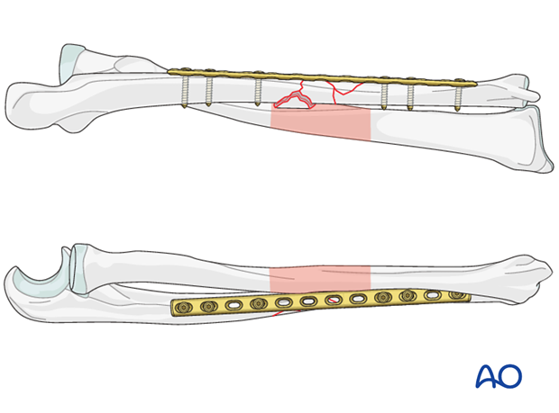 Assessment of overall forearm reduction