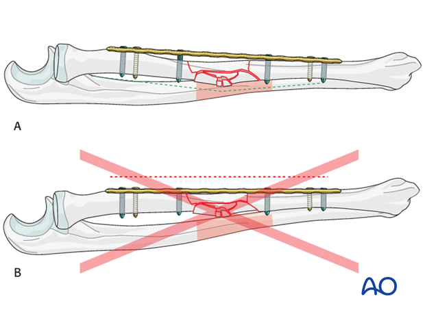 orif bridge plating