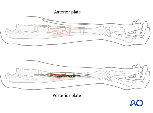 Plate position on the radius