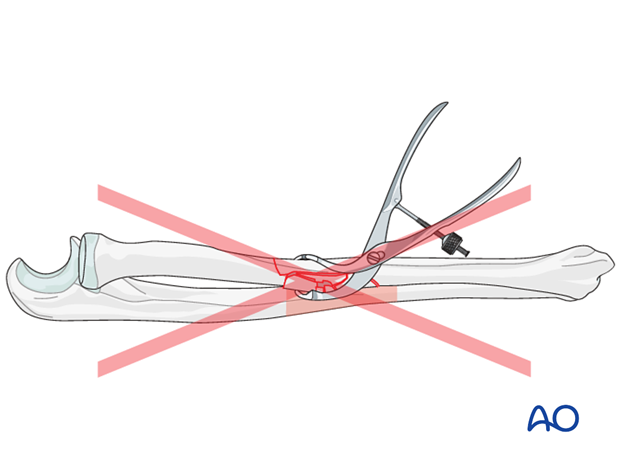 Soft-tissue considerations in comminuted zone