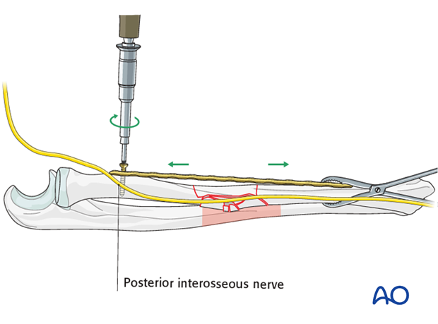 Preliminary fixation of the radius