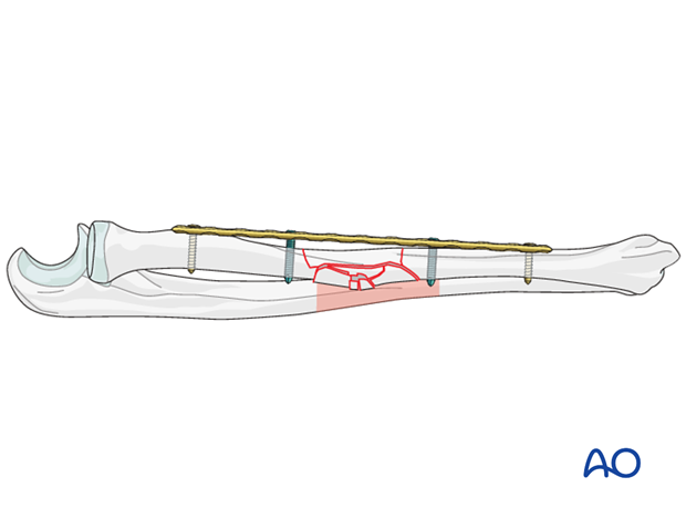 Preliminary fixation of the radius, screws