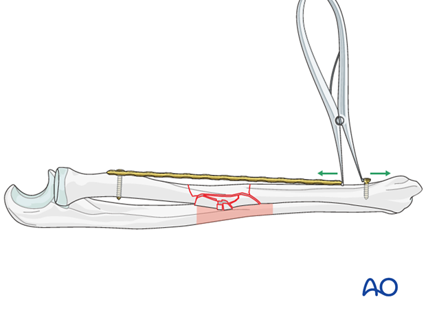 Reduction by help of the plate and distraction using a laminar spreader and a screw (push-pull technique)