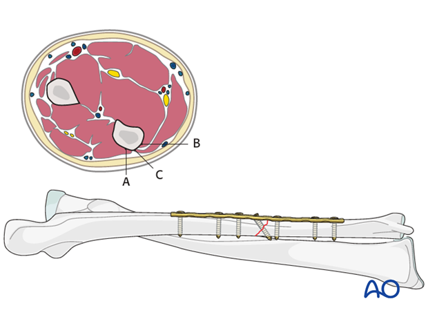 Ulnar plate positioning