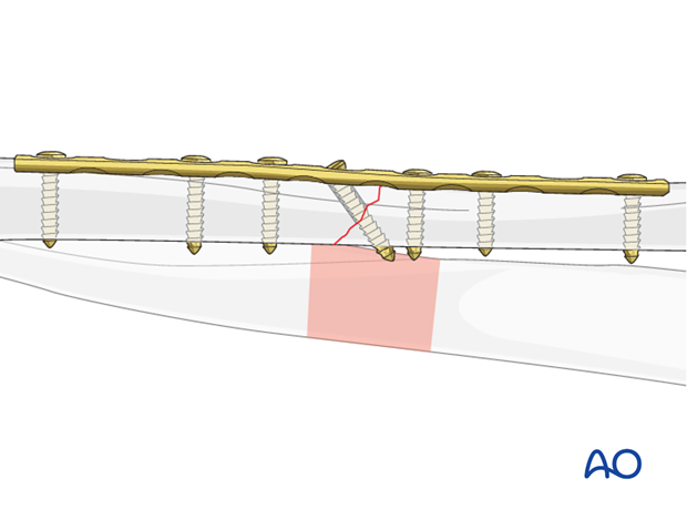 Cortical lag screw