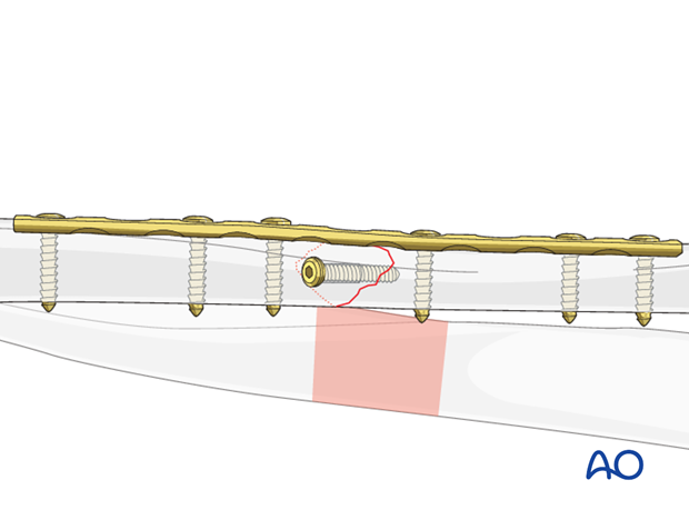 Lag screw as primary fixation device separate from plate