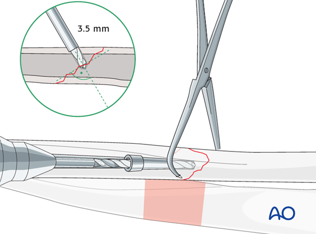 Drill gliding hole