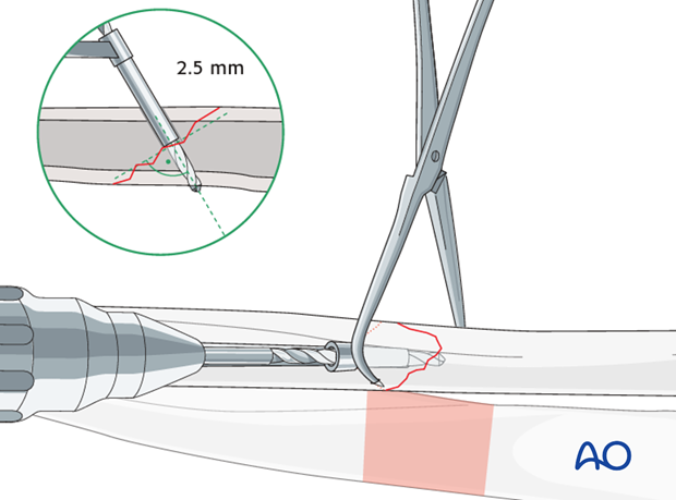 Thread hole: guide in gliding hole