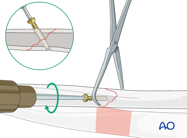 Lag screw insertion