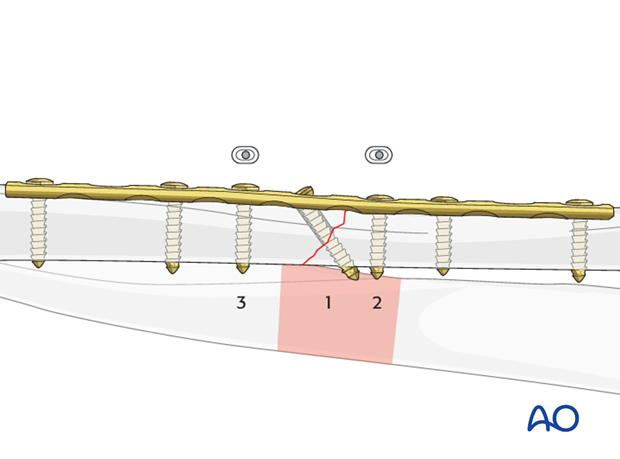 Lag screw as primary fixation device through the plate