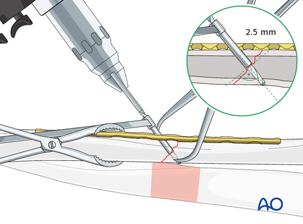 Thread hole: guide in gliding hole