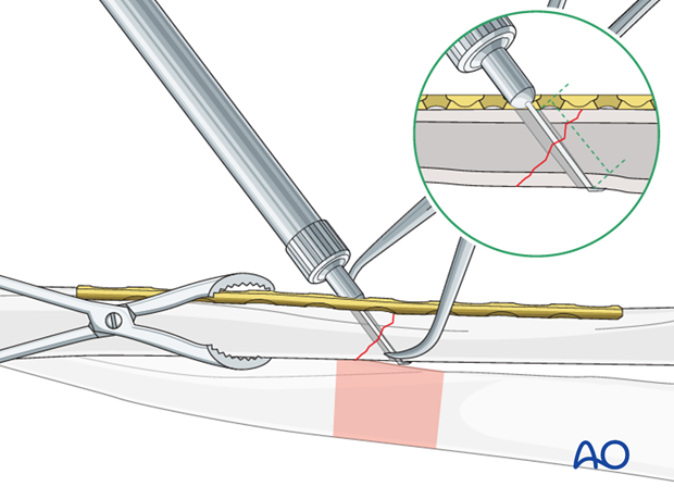 Measure for screw length