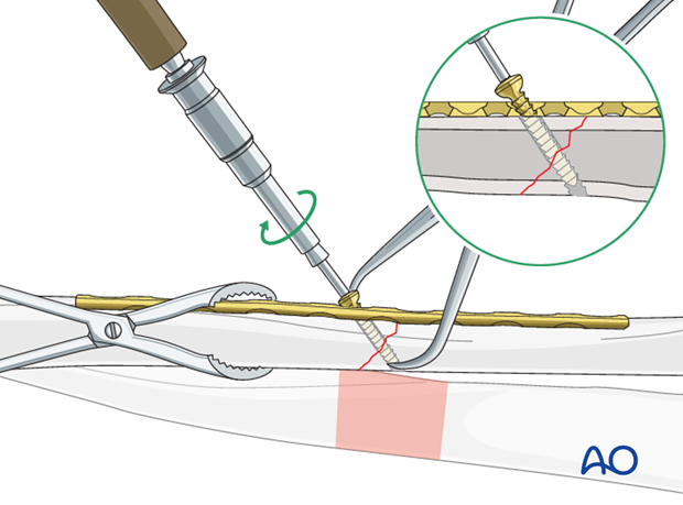 Lag screw insertion