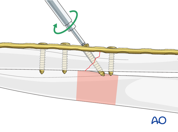 Lag screw