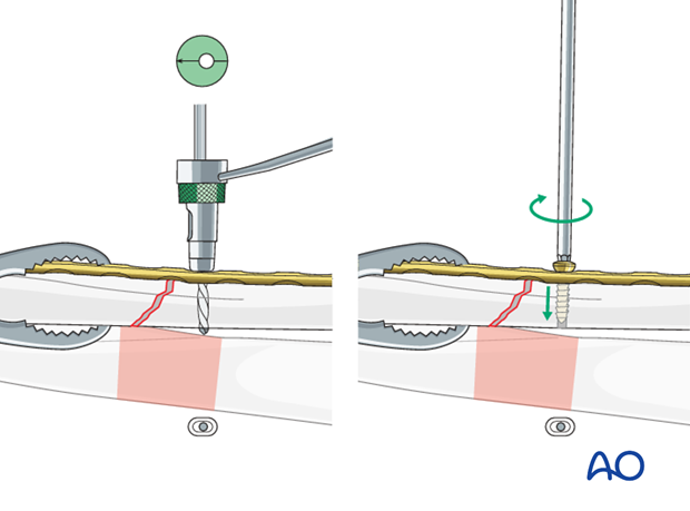 Insert 1st screw