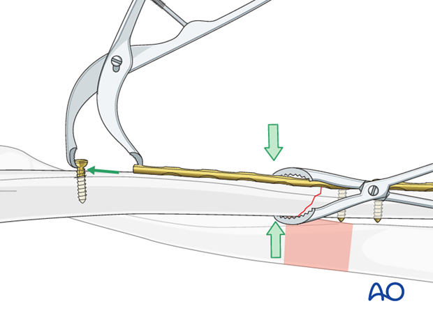 Axial compression with a small Verbrugge clamp