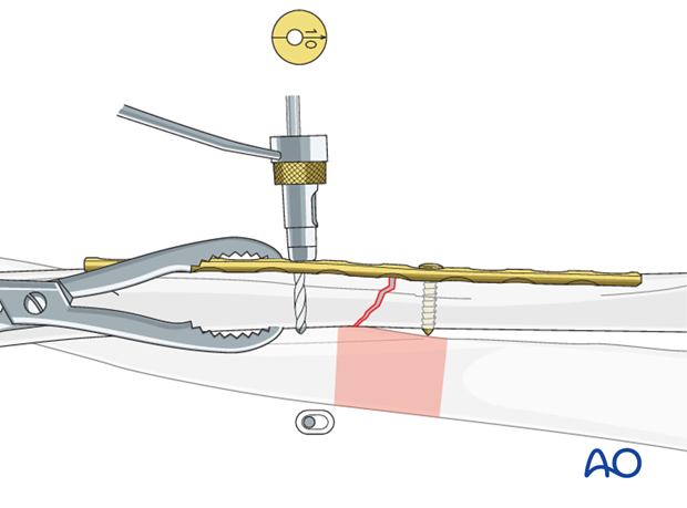 Insert 2nd screw eccentrically