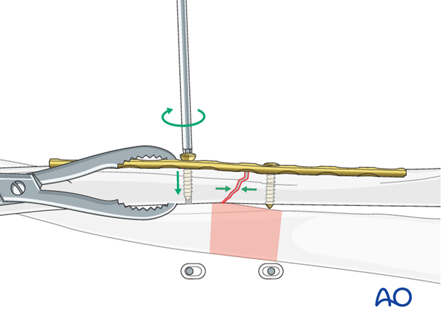 Axial compression