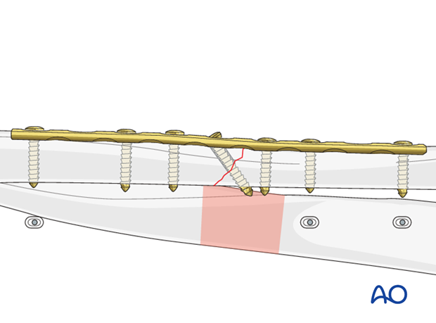 Ulnar plate fixation