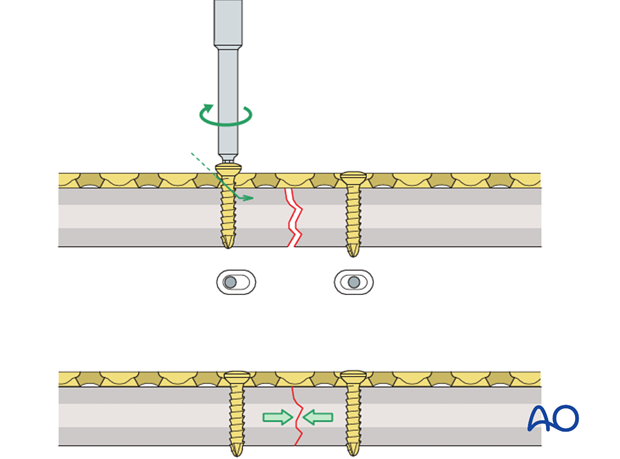 orif compression plating