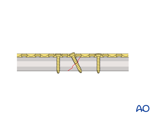 orif compression plating