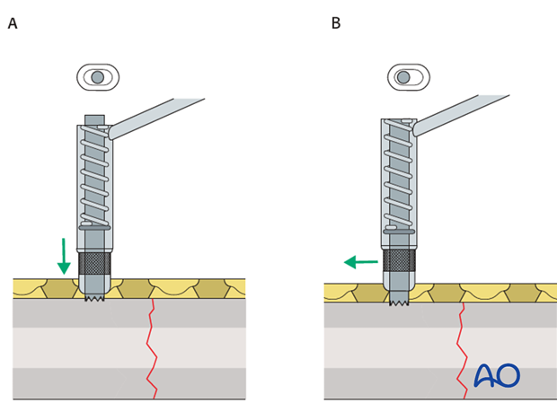 orif compression plating