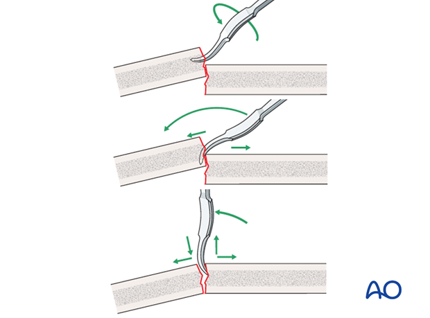 leverage technique for oblique fractures