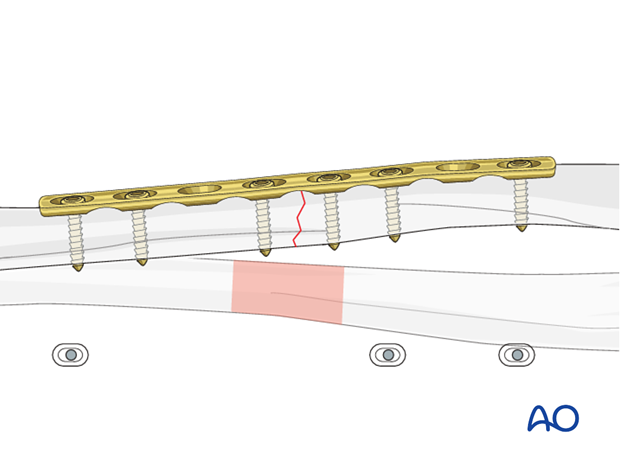 Plate length and number of screws