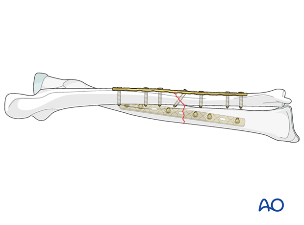 Completed osteosynthesis