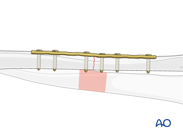 Plate length and number of screws