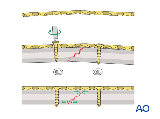 Fixation – compression plating with an additional lag screw