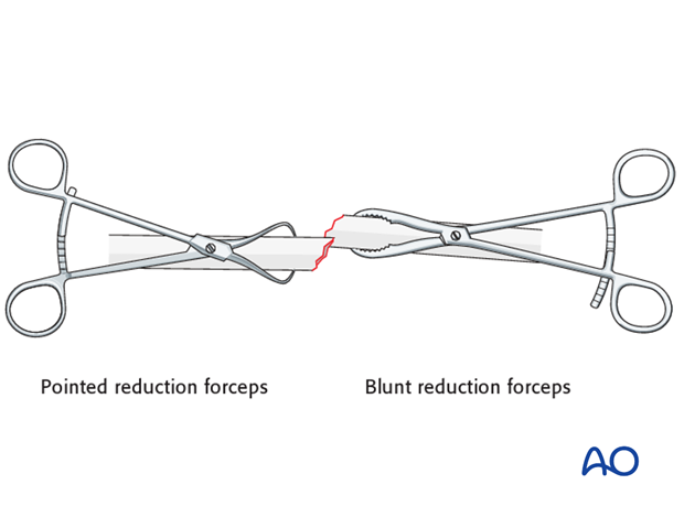 Open and anatomical reduction