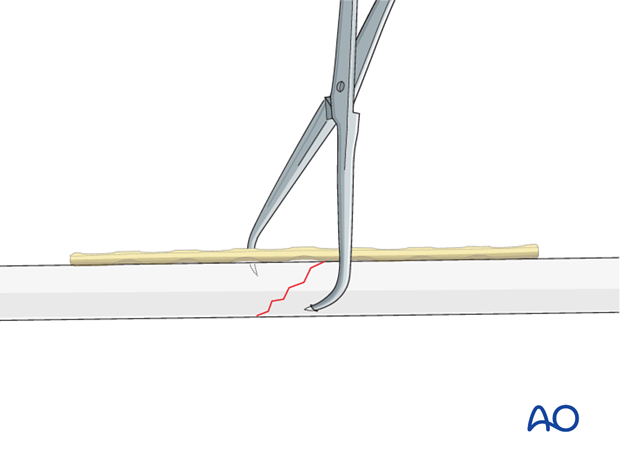 Maintain fracture reduction