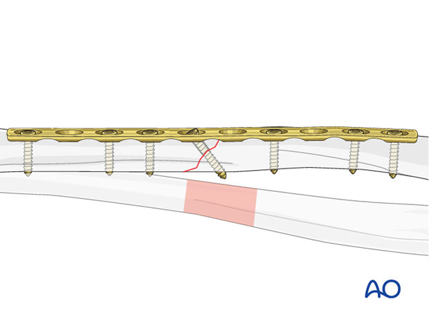 Plate length and number of screws