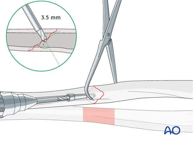 Fixation – lag screw as primary fixation device separate from plate