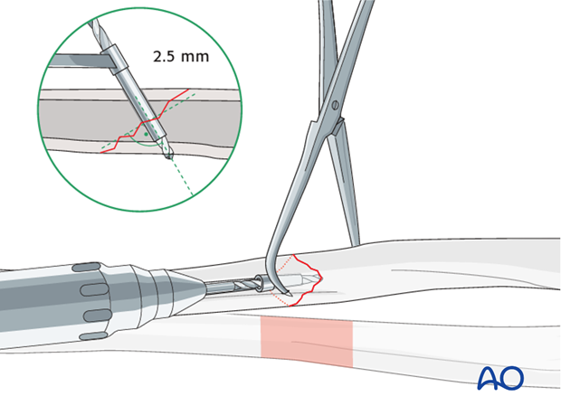 Fixation – lag screw as primary fixation device separate from plate