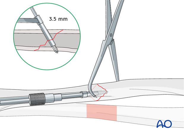 Fixation – lag screw as primary fixation device separate from plate