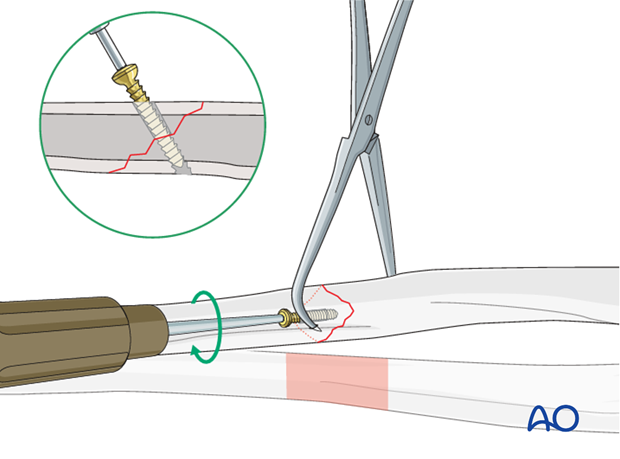 Fixation – lag screw as primary fixation device separate from plate