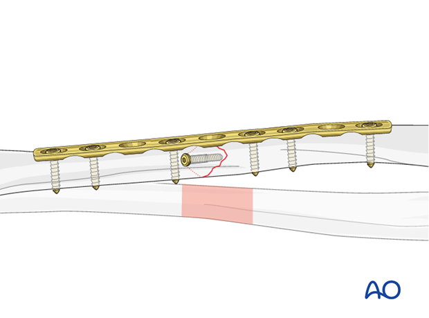 Fixation – lag screw as primary fixation device separate from plate