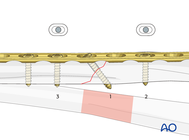 Fixation – lag screw as primary fixation device through the plate