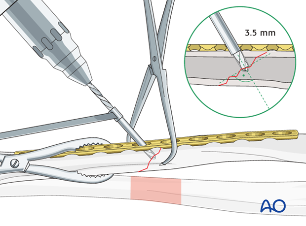 Fixation – lag screw as primary fixation device through the plate