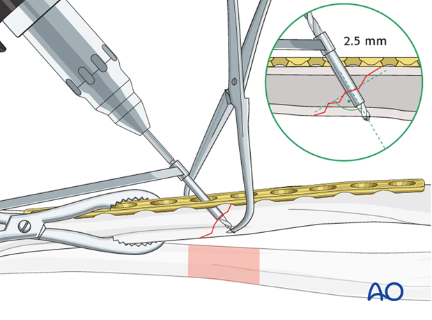 Fixation – lag screw as primary fixation device through the plate