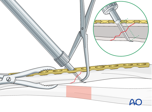 Fixation – lag screw as primary fixation device through the plate