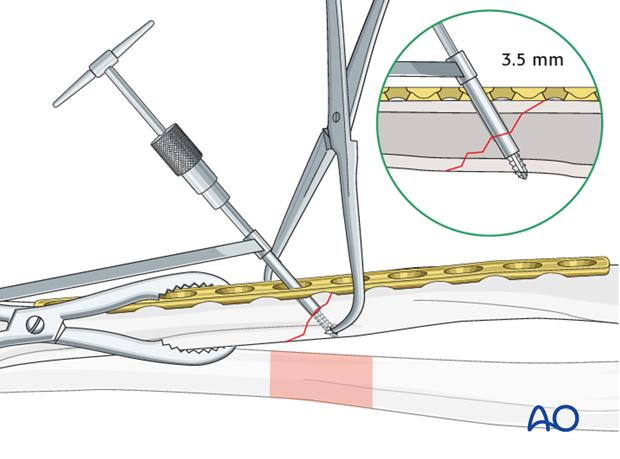 Fixation – lag screw as primary fixation device through the plate