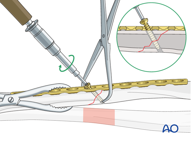 Fixation – lag screw as primary fixation device through the plate