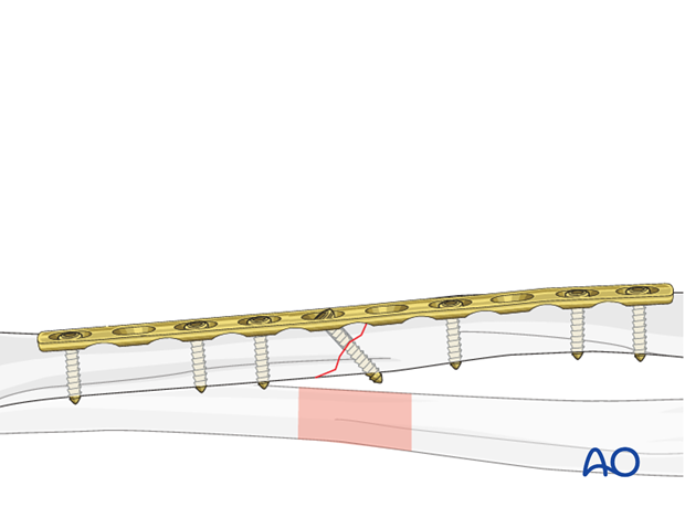 Fixation – lag screw as primary fixation device through the plate